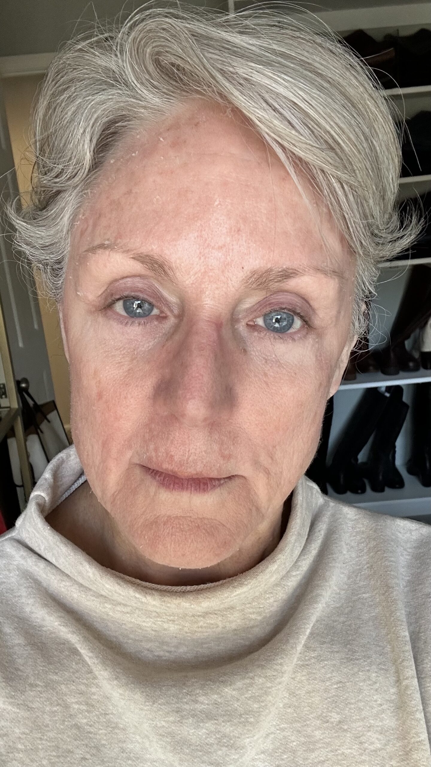 Chemical Peel Day 2 Chemical Peel Day 2