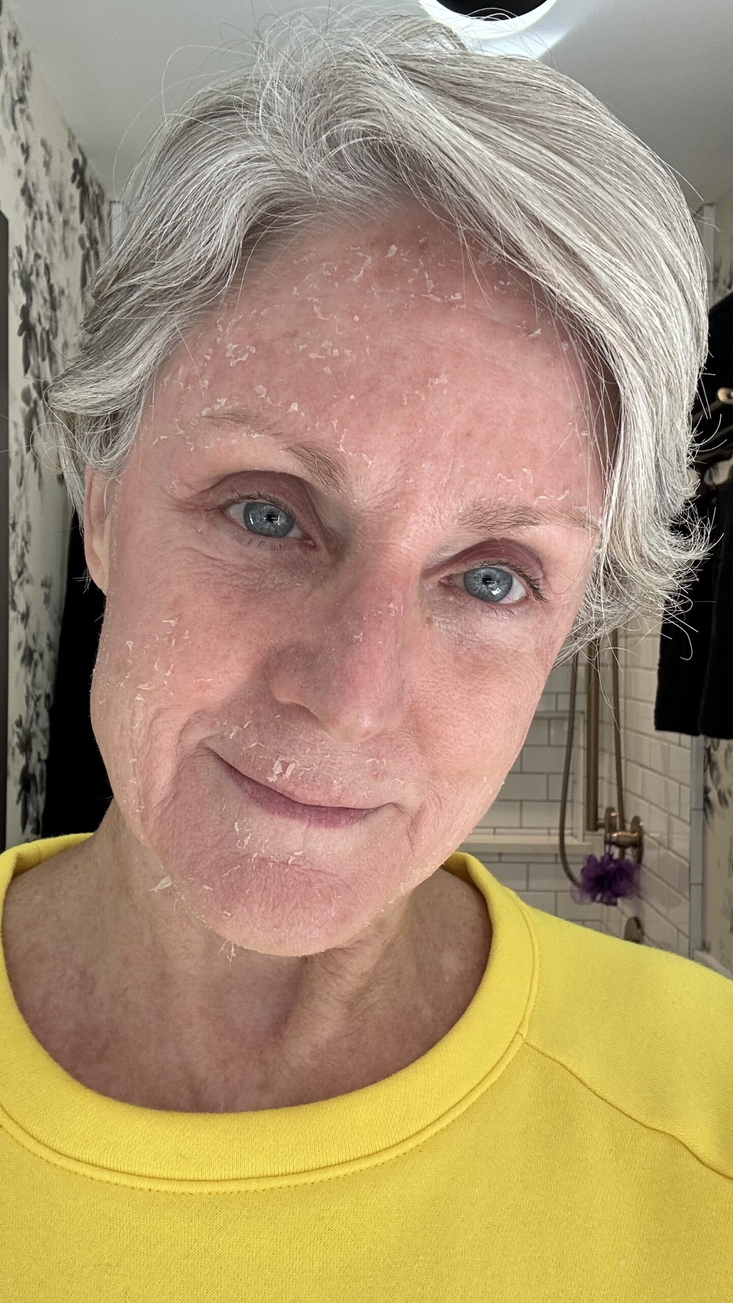 Chemical Peel Day 3 Chemical Peel Day 3