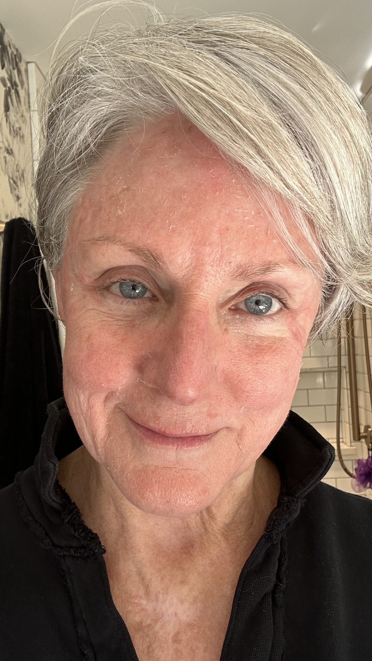 Chemical Peel Day 4 Chemical Peel Day 4