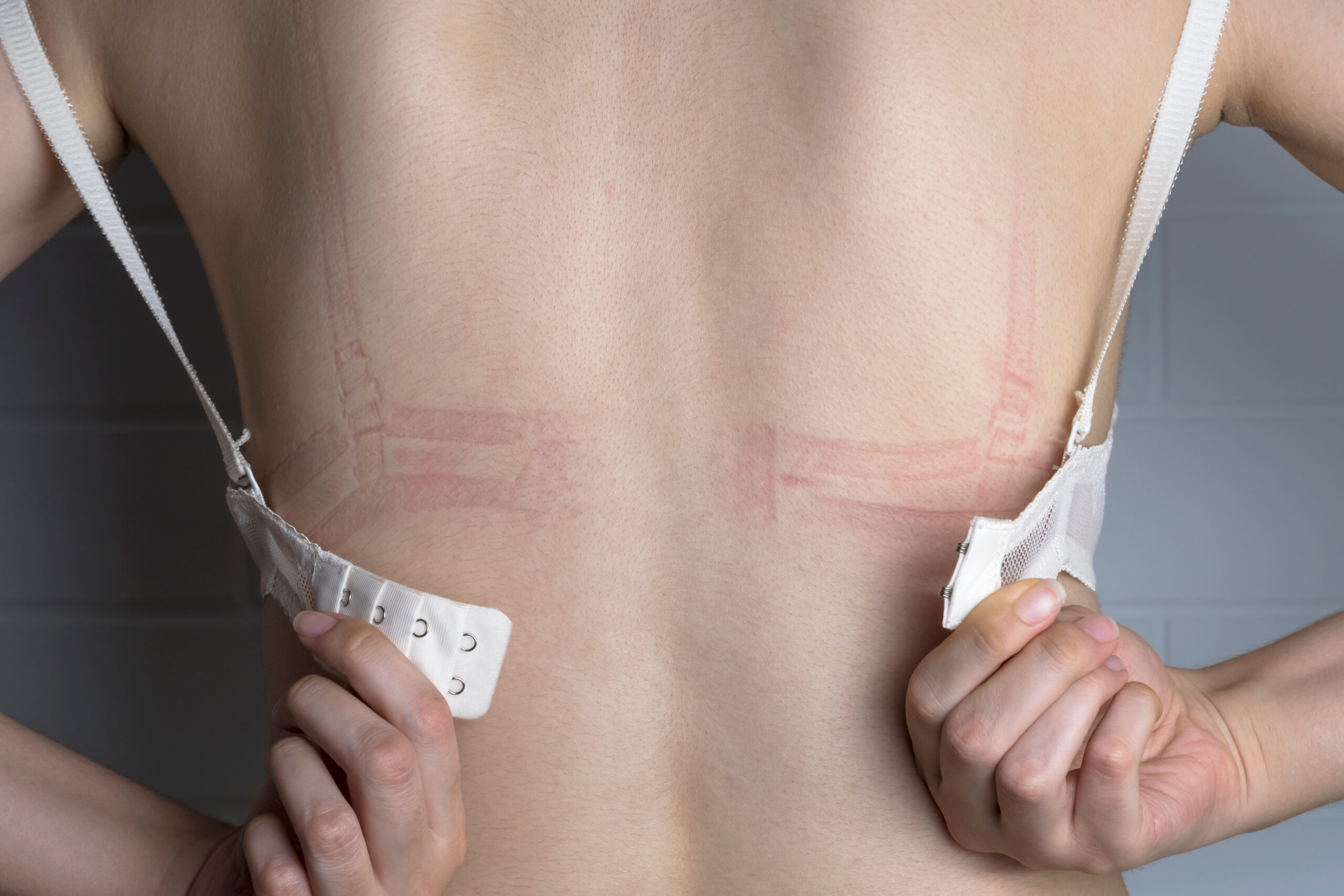 Bra,Marks,On,The,Back.,The,Girl,Rubbed,Her,Back Bra,Marks,On,The,Back.,The,Girl,Rubbed,Her,Back